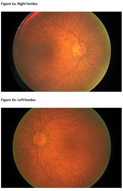 Glaucoma retina